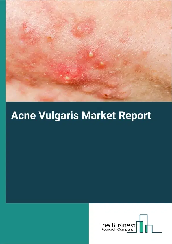 Global Acne Vulgaris Market Report 2026